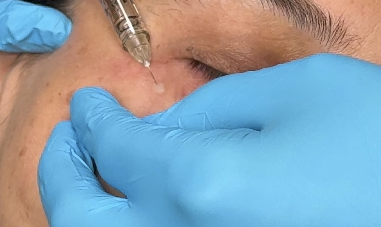 Sunekos injection