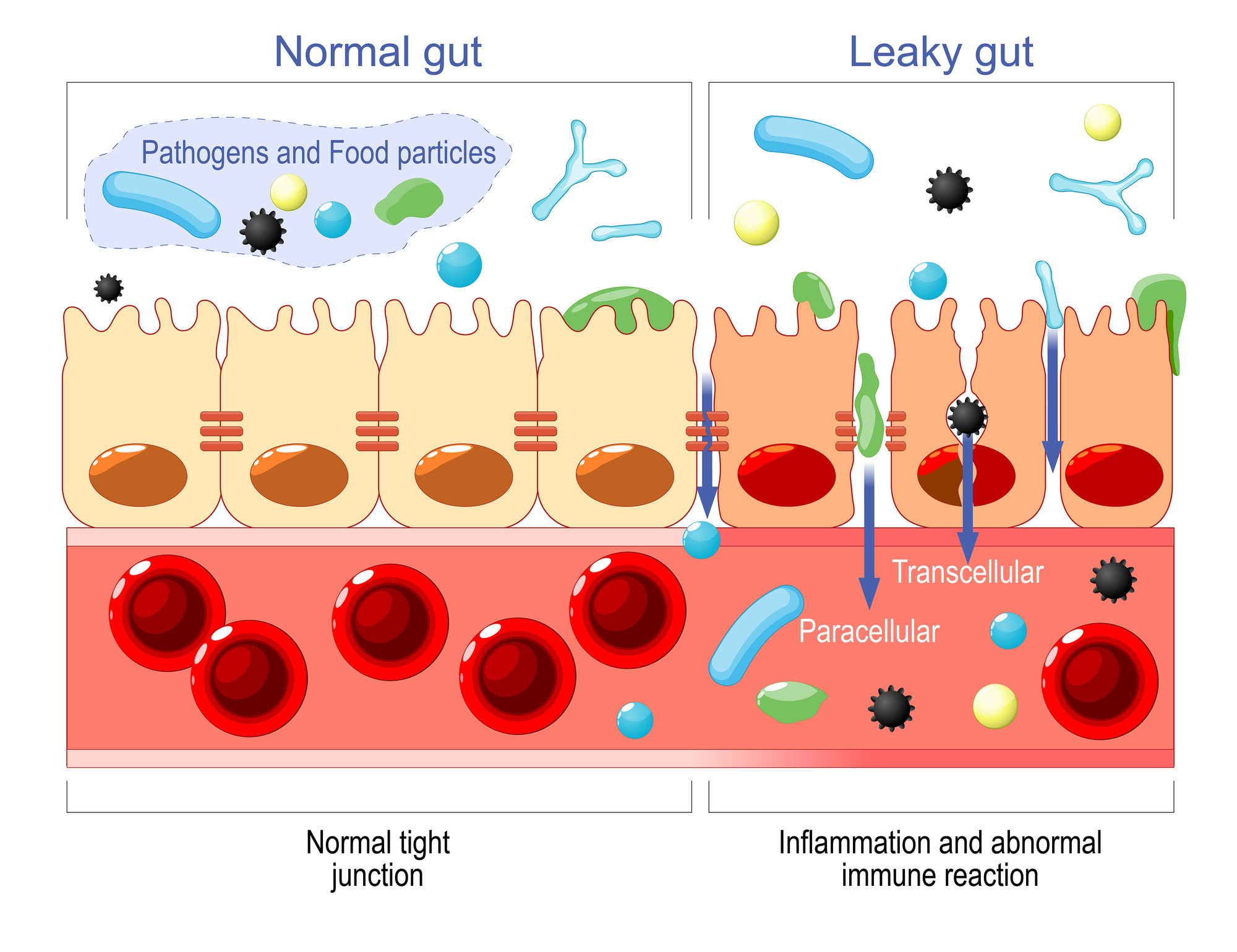 leaky gut