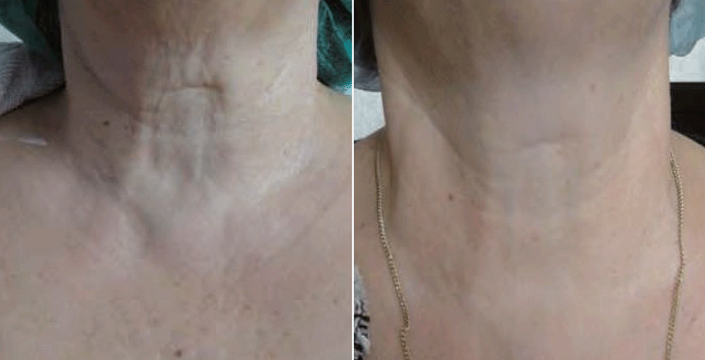 neck jalupro