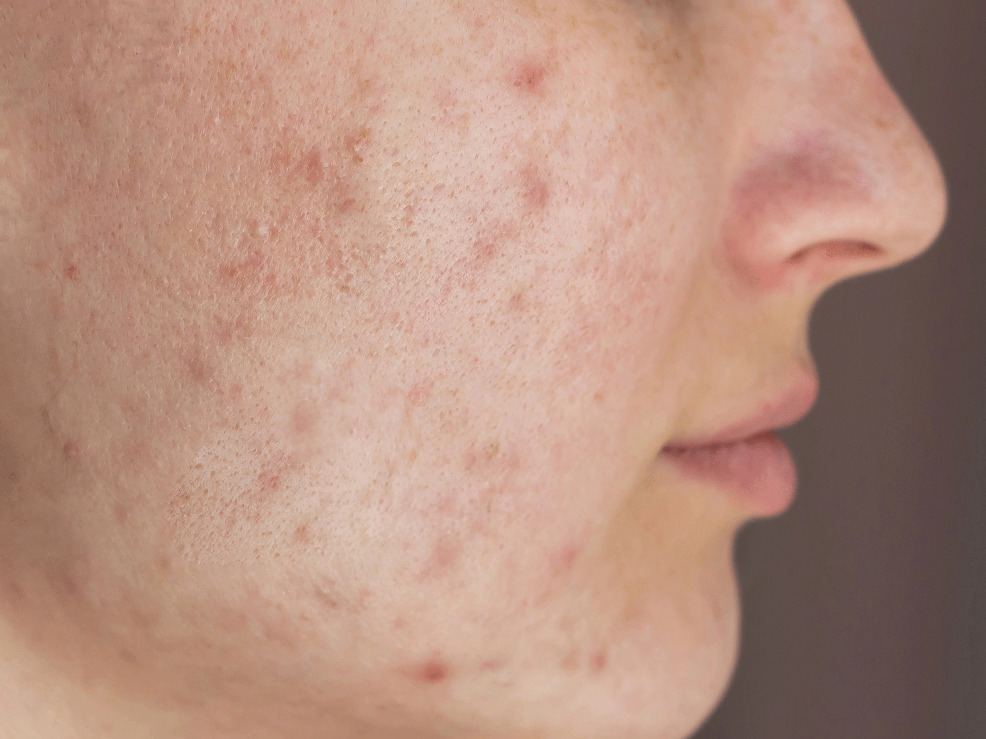 Acne vulgaris Narben