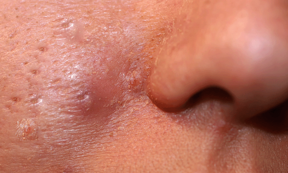 Infektion Filler<br />
Biofilm