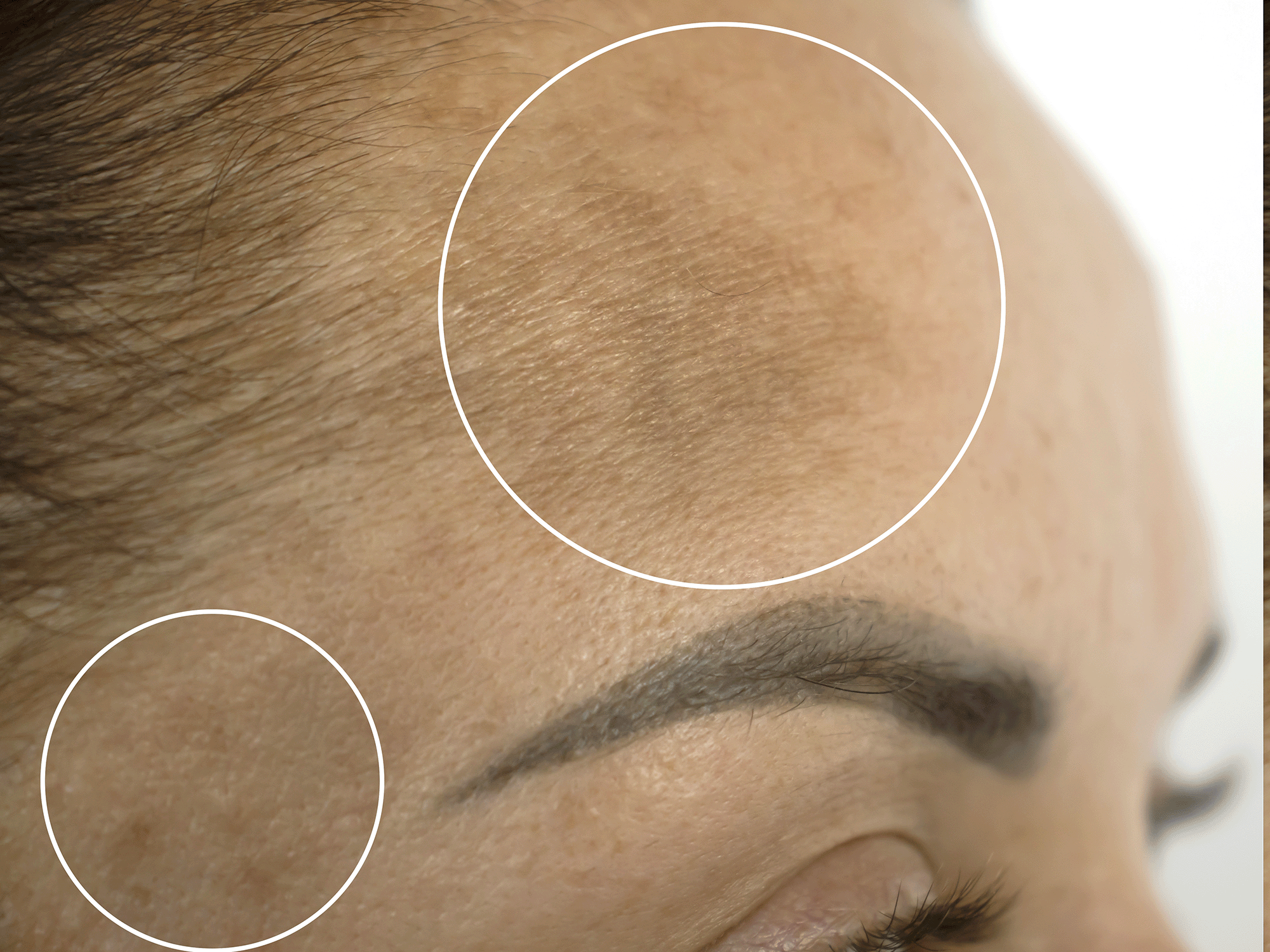 Melasma Pigmentation