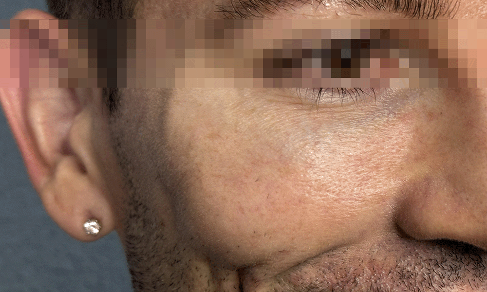 overfilled face<br />
filler migration